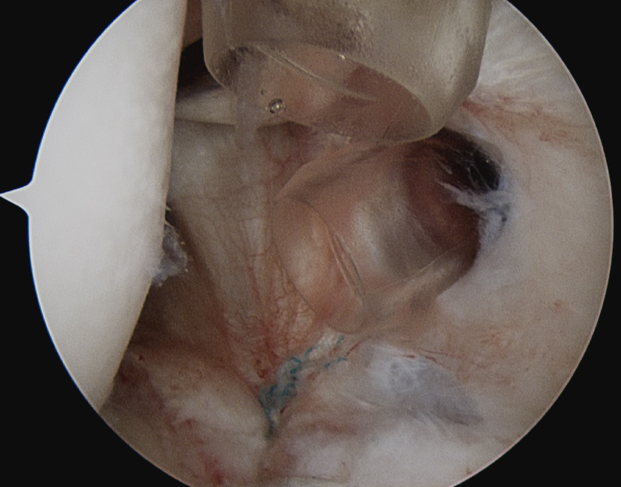 Posterior Labral Tear 1